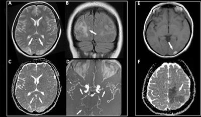 Posterior Reversible Encephalopathy Syndrome in Guillain-Barré Syndrome: Just a Problem of Immunoglobulins? Controversy From Two Atypical Case Reports